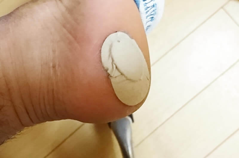 痛い魚の目の原因と自分でできる治療法。皮膚科での手術までのまとめ! 痛い魚の目の原因と自分でできる治療法。皮膚科での手術までのまとめ!